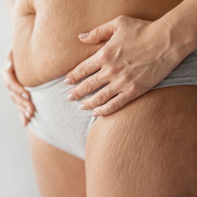 Body treatments