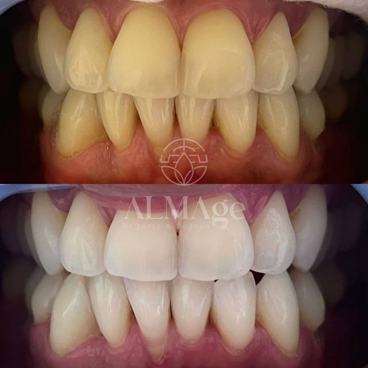DaVinci Teeth Whitening